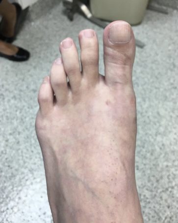 Bunion, after