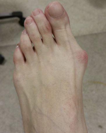 Bunion, before