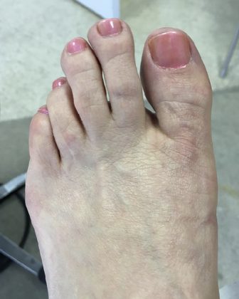Bunion, after