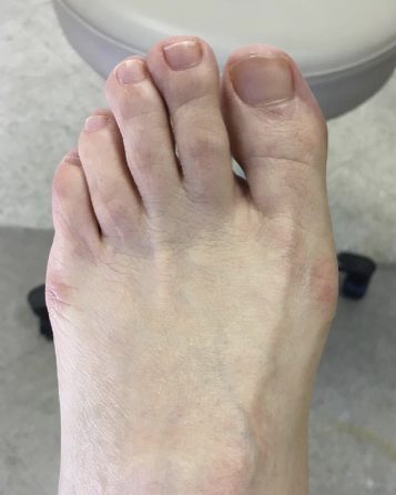 Bunion, before