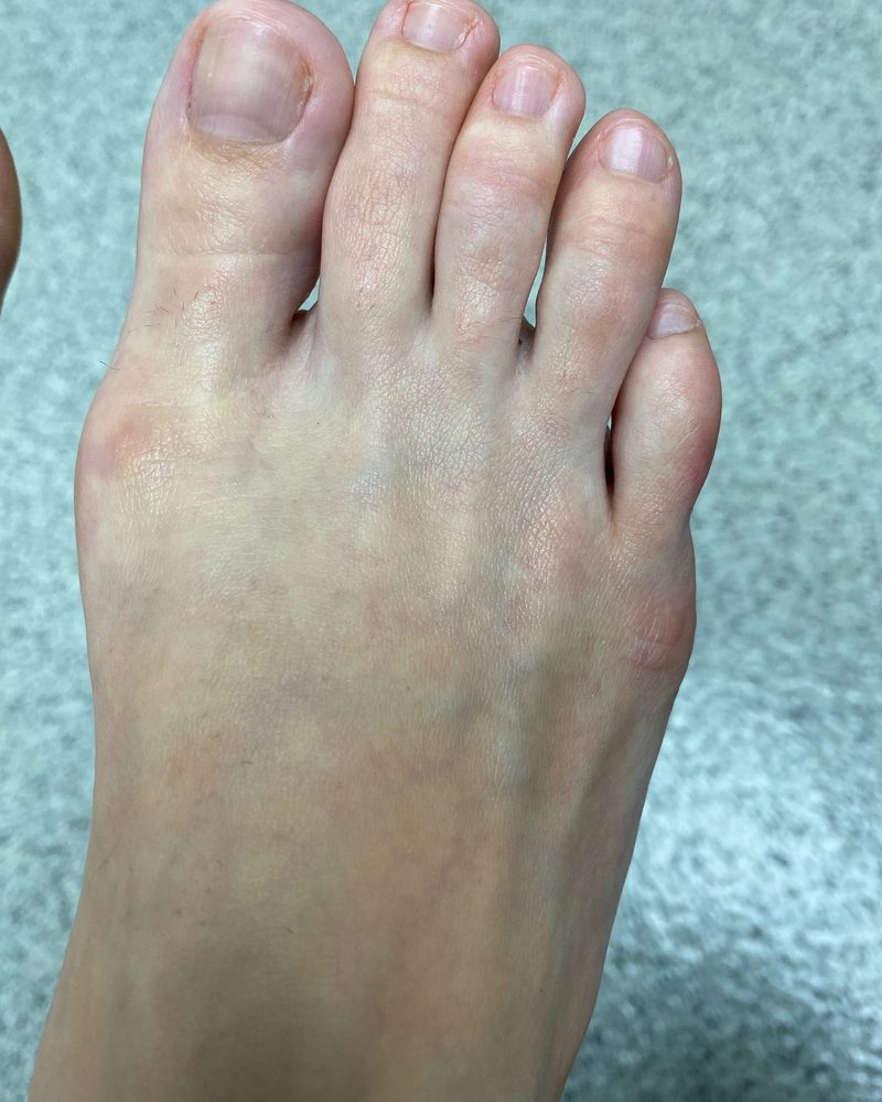 Bunion, after