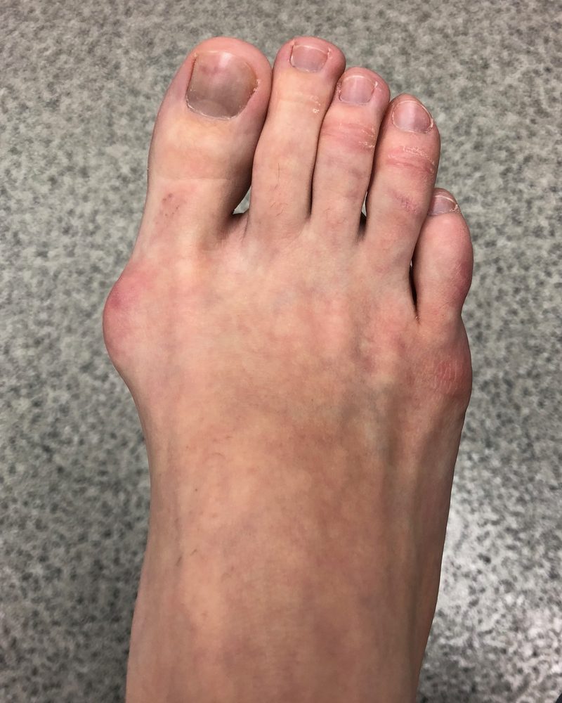Bunion, before