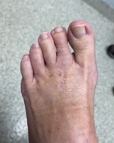 Hammertoe, two weeks after