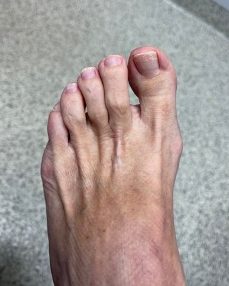 Hammertoe, before