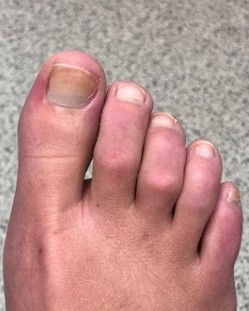 Hammertoe, after