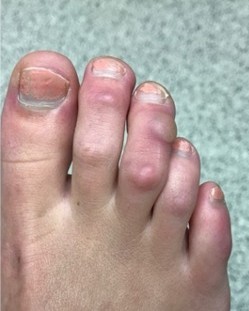 Hammertoe, before